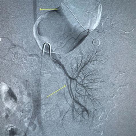 -Second renal angiogram confirmed rapid visualization of draining... | Download Scientific Diagram