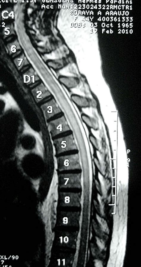 Case 1.MRI of cervical and thoracic spinal cord showing T2-weighted ...