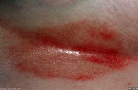 excoriation skin folds | - LIFE SUPPORT