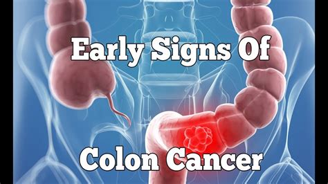 Blood In Stool Colon Cancer Symptoms Images