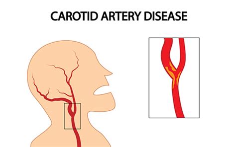 Neurovascular: Carotid artery disease - Symptoms, Treatments | SingHealth