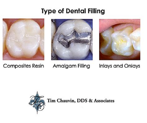 types of fillings Archives - Dr Chauvin