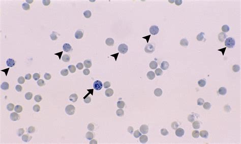 Reticulocytes – Cells and Smears