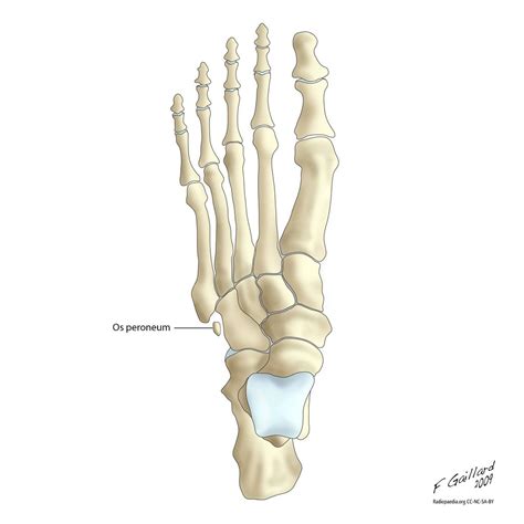 Os Peroneum Radiology Quiz 7643 | Radiopaedia.org | Medical illustration, Radiology, Vision eye