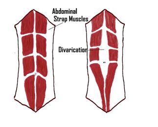 What is Divarication? | Hernia Repair Brisbane