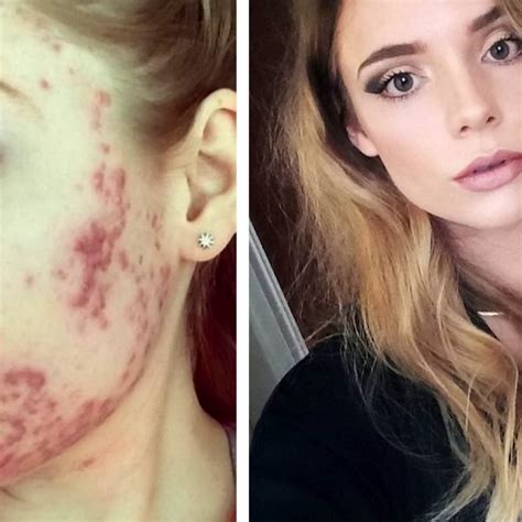 “Disease Face” – Girl Who Had Horrific Acne As A Teen Beats Trolls To ...