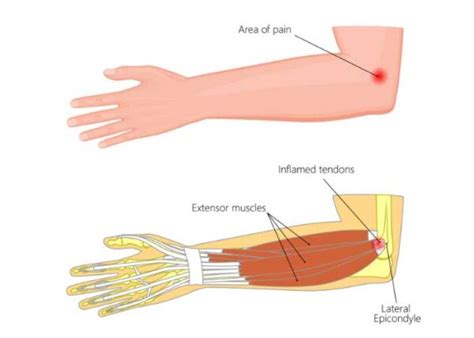 Lateral Epicondylitis |Tennis Elbow |Extensor Capri Radialis Brevis Tendon Tear| Orthopedic ...