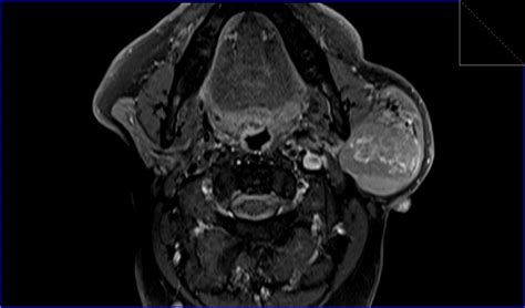 Warthin's tumor MRI