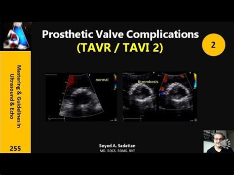 Prosthetic Aortic Valve Complications: TAVR / TAVI 2 - YouTube