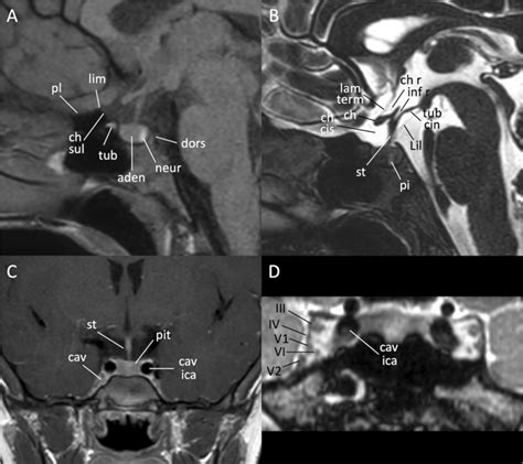 MR anatomy of the sellar region. Sagittal T1- (A), 3D high resolution ...