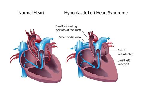 Hypoplastic Left Heart Syndrome: Managing a Congenital Heart Defect - Longmore Clinic