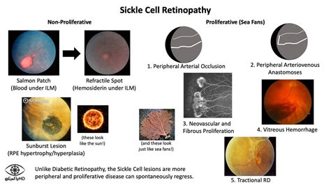 Sickle Cell Retinopathy Sea Fan