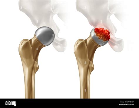 Femoral Head Disease and osteonecrosis or avascular necrosis and aseptic necrosis with a healthy ...