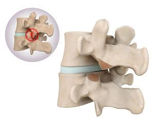 Lumbar Foraminotomy