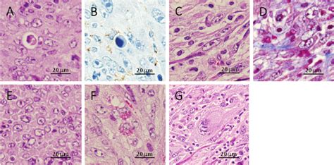 High magnification of the tumor cells. A) Phagocytosis of cell debris... | Download High ...