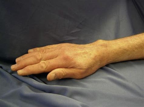 Typical ulnar head prominence seen with dorsal DRUJ instability ...