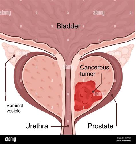 Medical diagram of 2 stages of prostate cancer. tumor grows and penetrates into neighboring ...