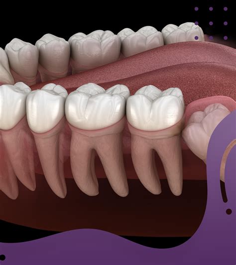 Operasi Gigi Bungsu - Klinik DENTA: