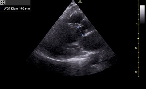 emDOCs.net – Emergency Medicine EducationPOCUS for Aortic Stenosis - emDOCs.net - Emergency ...