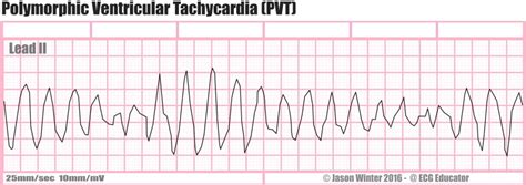 What is Ventricular Tachycardia (V-Tach)? - Boss RN