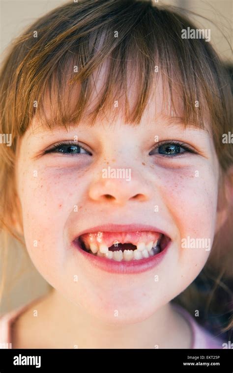 Young Girl With Missing Front Teeth; Gold Coast Queensland Australia Stock Photo, Royalty Free ...