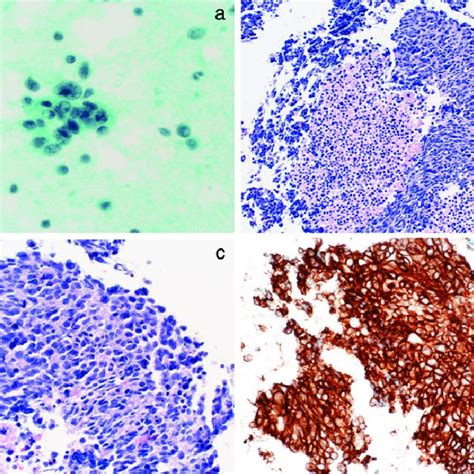 Cytological/histological diagnosis of large cell neuroendocrine ...