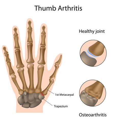 Trapeziectomy - Trapeziectomy Thumb Surgery - Horder Healthcare