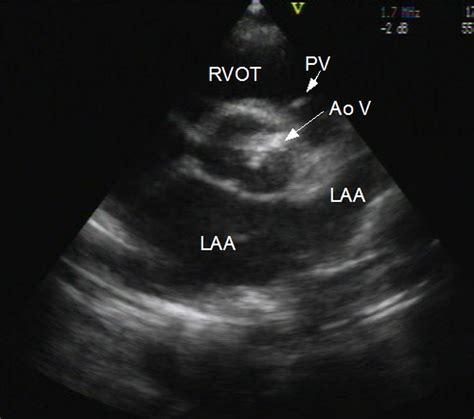 Aortic stenosis: Echocardiogram in parasternal short axis view – All ...