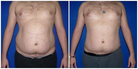 Patient #276 Male Liposuction Before and After Photos Katy - Plastic ...