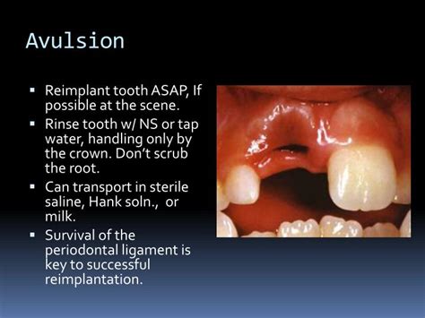 PPT - Oral dental emergencies PowerPoint Presentation - ID:1880246