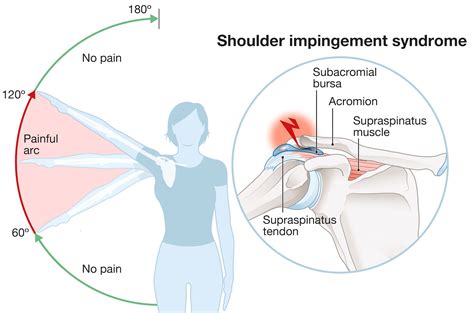 Shoulder Impingement Syndrome Causes, Treatment, & Prevention