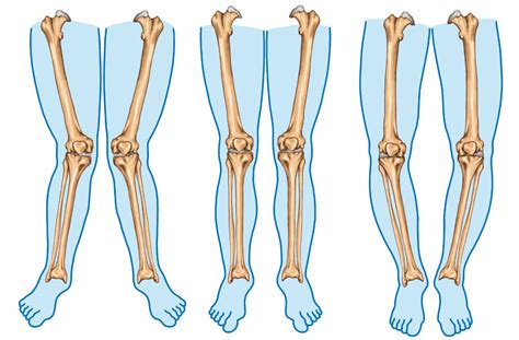 Valgus And Varus Knee Patterns And Knee Pain | 3D Muscle Lab