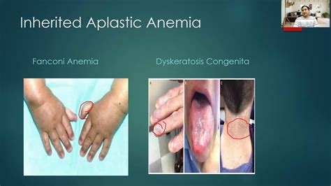 Aplastic anemia|Dr Bhupendra Shah|medicine classroom - YouTube