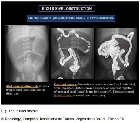 TRIPPLE BUBBLE (JEJUNAL ATRESIA) – radiologi.id