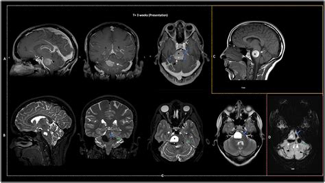 Frontiers | Case report: Delayed outflow obstruction of a DVA: A rare ...