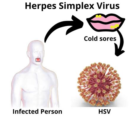 Herpes Simplex Virus: Types, Causes, and Treatment