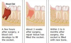 Tooth Extraction | Platelet Rich Fibrin Therapy - Valley of the Sun Dentistry | Family Dentist ...