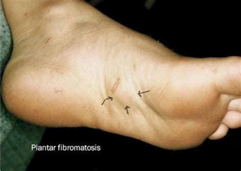 19+ Plantar Fibroma Picture - KaranYazmin