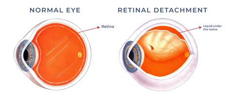 Symptoms of a retinal detachment | Front Range Retina