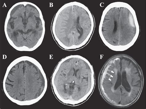 CT findings demonstrating examples of five types (A-E) and MRI finding... | Download Scientific ...