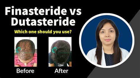 Finasteride vs Dutasteride: Which is better? | Finasteride and ...