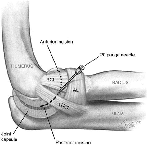 The effect of arthroscopic sectioning of the lateral ligament complex of the elbow on ...