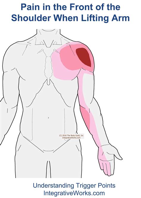 Pin on physio Trigger points