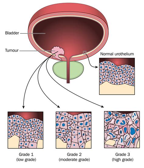 Bladder Cancer Symptoms: Seek an Evaluation for Early Detection - University Health News