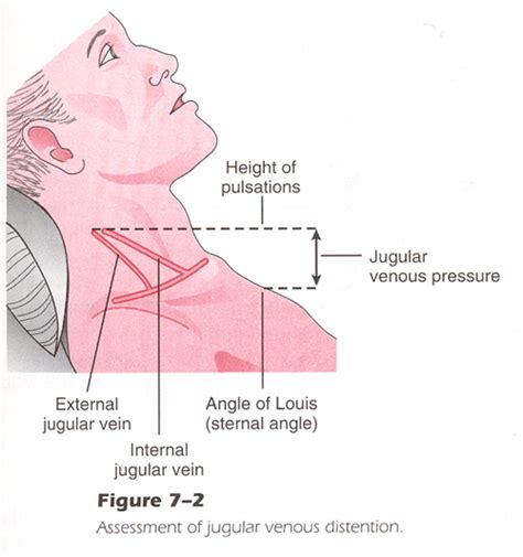 Best Way To Assess Jvd - Just For Guide