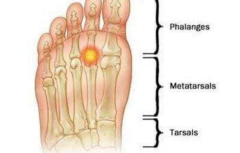 What is Metatarsalgia? Metatarsalgia Causes and Treatment