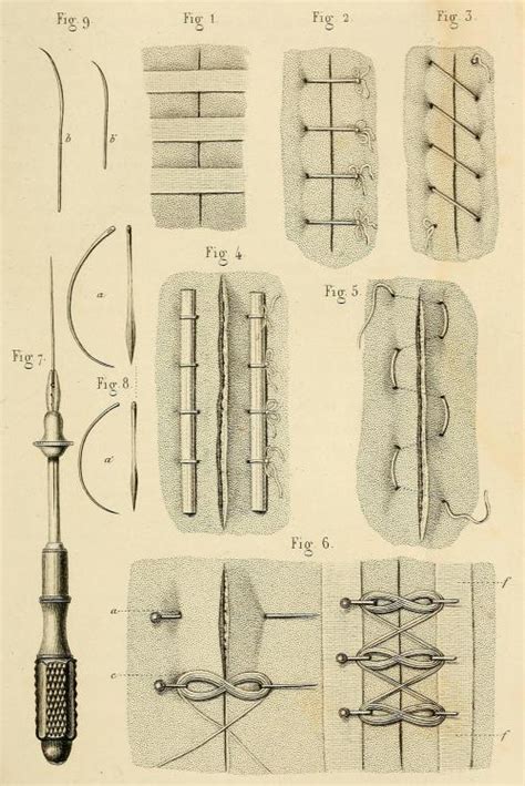 Wound closure techniques ca. 1855. Fig 1. Closure... - Biomedical ...