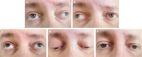 Bilateral Internuclear Ophthalmoplegia in Multiple Sclerosis | NEJM