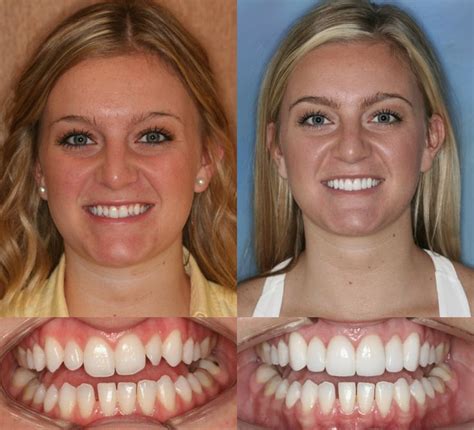 Pin by Conessa Webb on Teeth | Veneers teeth, Dental veneers, Dental cosmetics