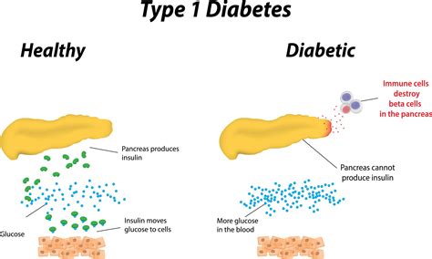 Causes of Type 1 Diabetes